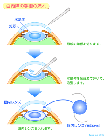 白内障の手術の流れ