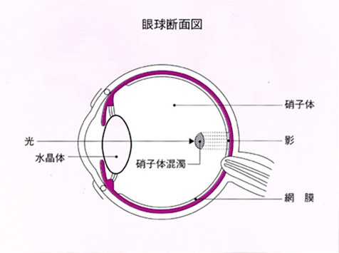 飛蚊症