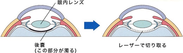 後発白内障の手術